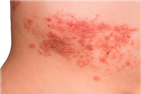 Опоясывающий лишай