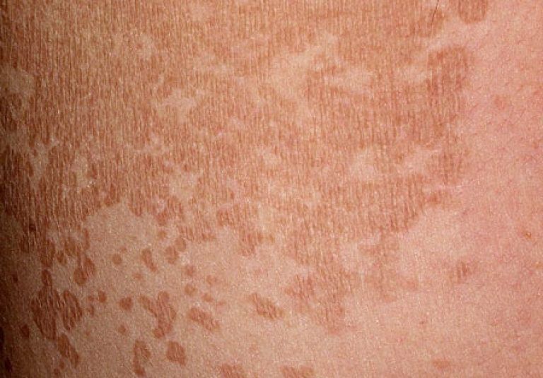 Отрубевидный лишай