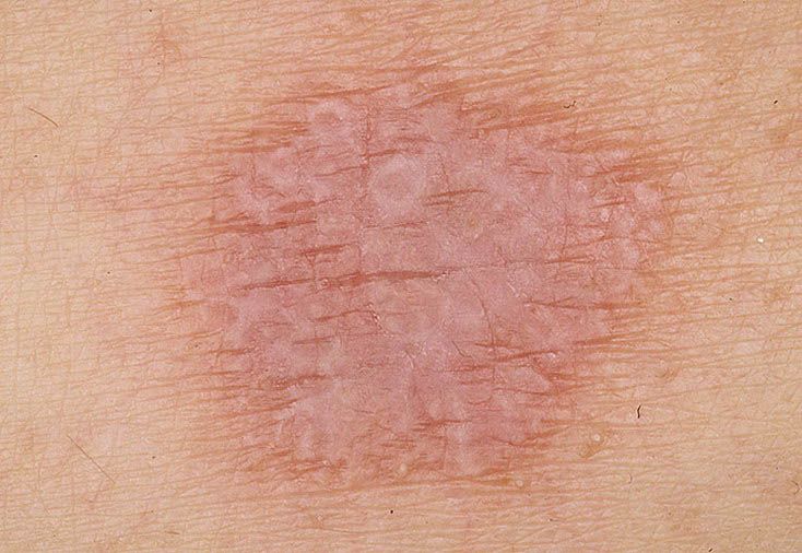 Красный плоский лишай