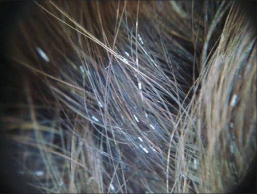 Узловатый лишай