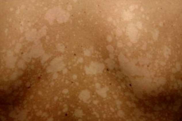 Солнечный лишай