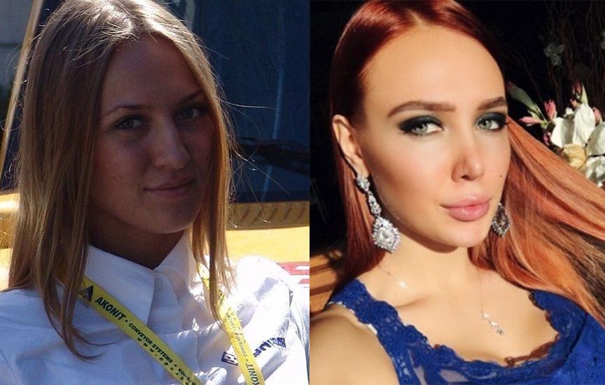 Лиза Полыгалова до&nbsp;и&nbsp;после пластики