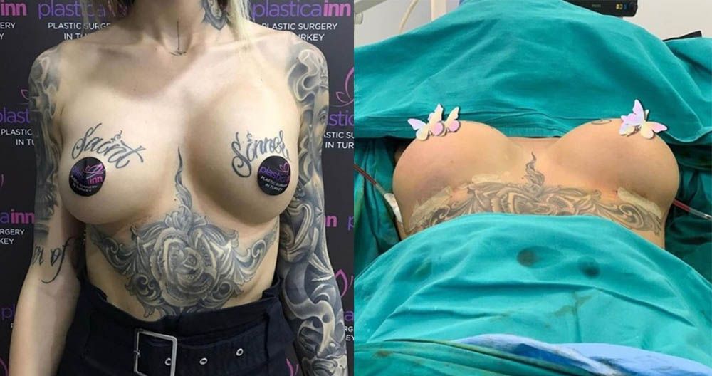 Марина Мексика до&nbsp;и&nbsp;после маммопластики