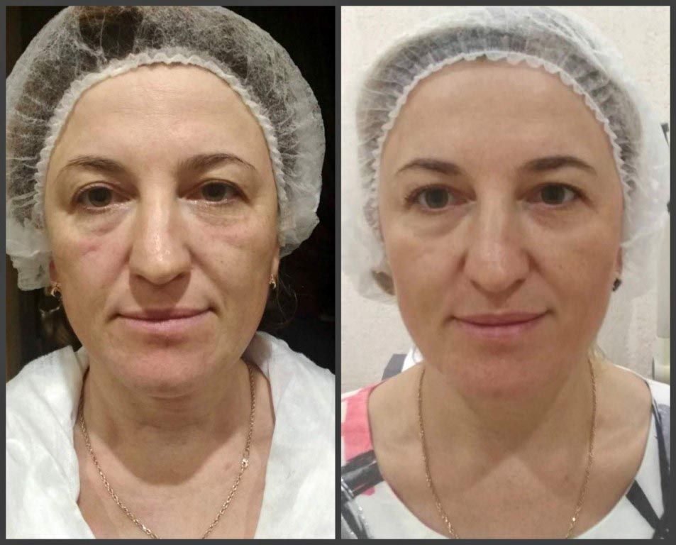 Инъекции Мезоскульпт для&nbsp;улучшения контура лица