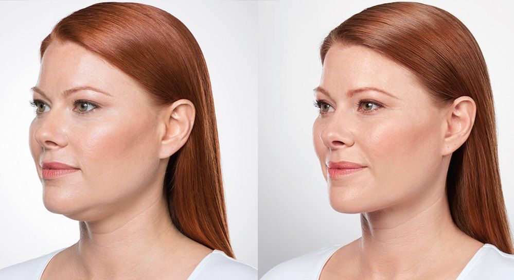 Борьба со&nbsp;вторым подбородком