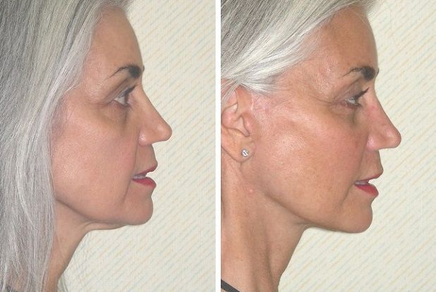 Устранение жира в&nbsp;зоне подбородка