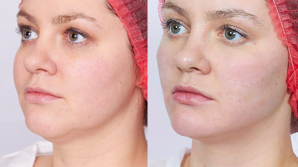 4 процедуры с&nbsp;интервалом в&nbsp;10 дней