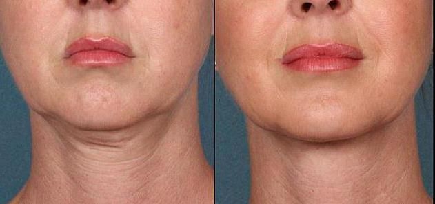 курс из&nbsp;6 процедур