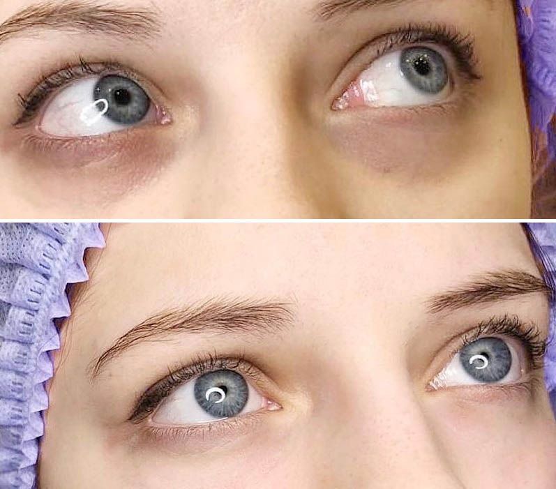 Борьба с&nbsp;синяками под&nbsp;глазами