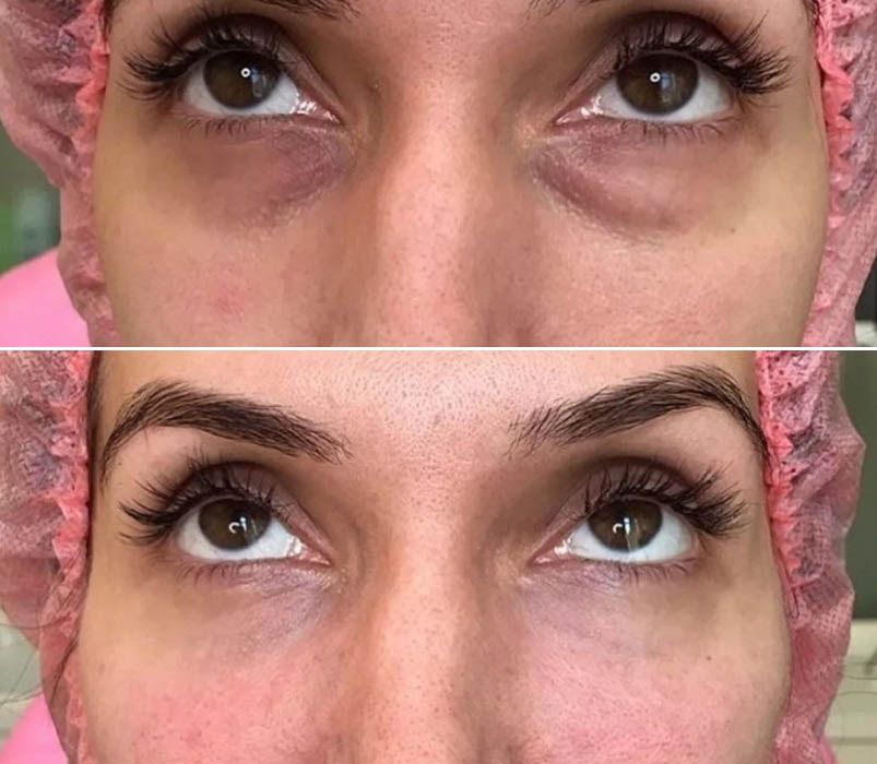 Эффект от&nbsp;применения Мезоай при синяках и&nbsp;отеках