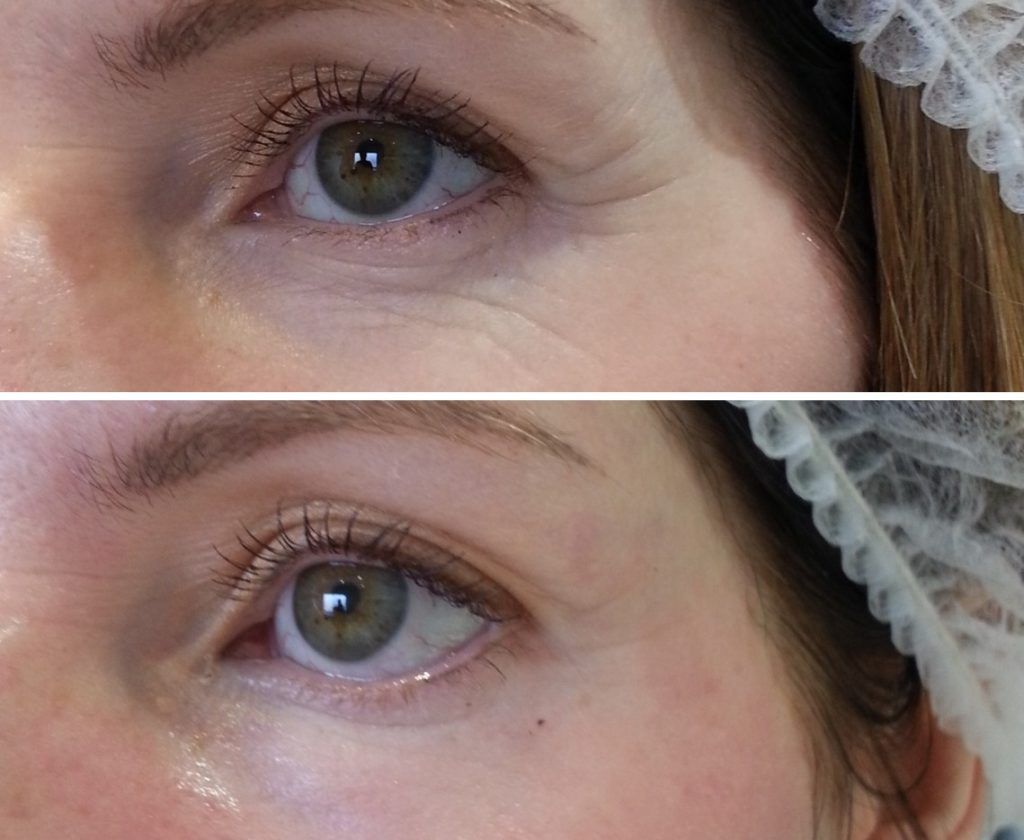 Борьба с&nbsp;мелкими морщинами и&nbsp;сухостью глаз