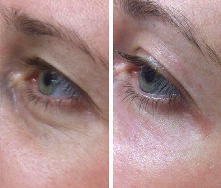 Борьба с&nbsp;морщинами под&nbsp;глазами