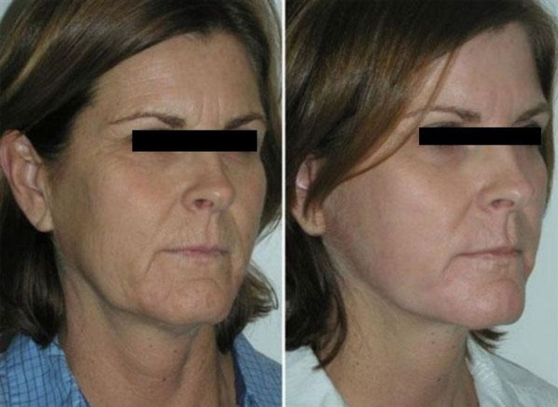 Мезоксантин