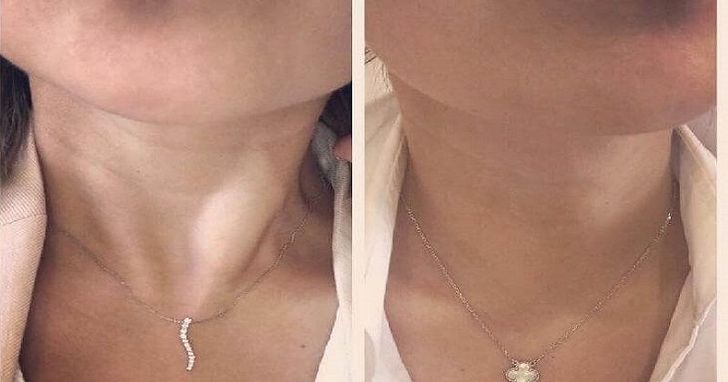 Эффект лифтинга шеи