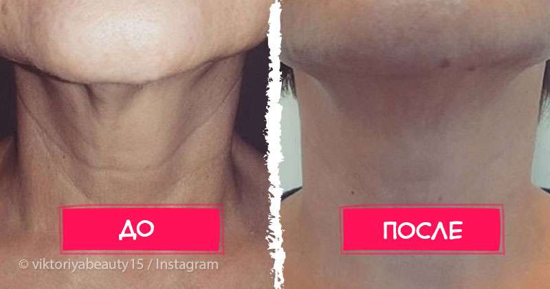 Комплексное фотоомоложение шеи