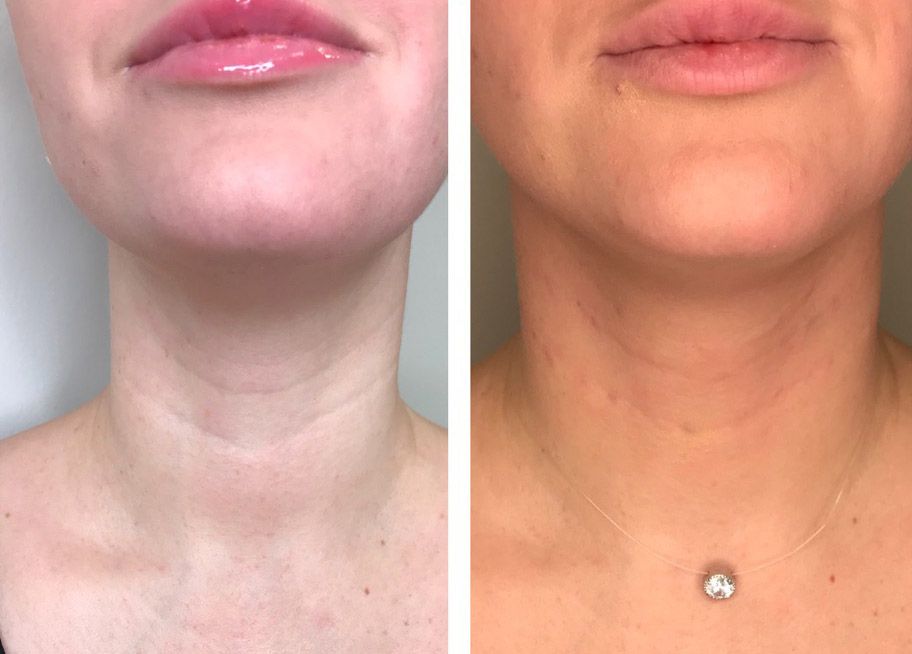 Эффект от курса пиллинга шеи