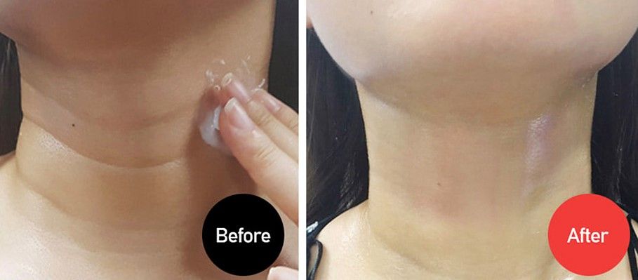 Фото до после инъекций гиалуроновой кислоты