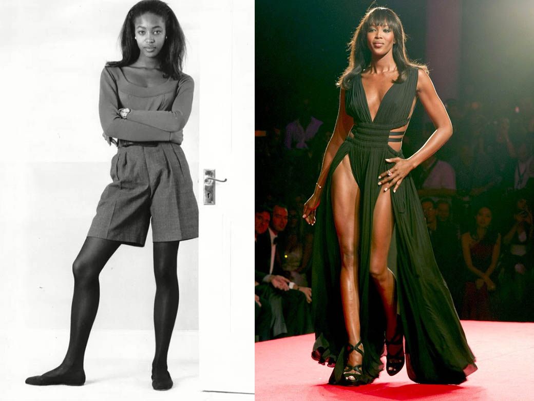 Липосакция Наоми