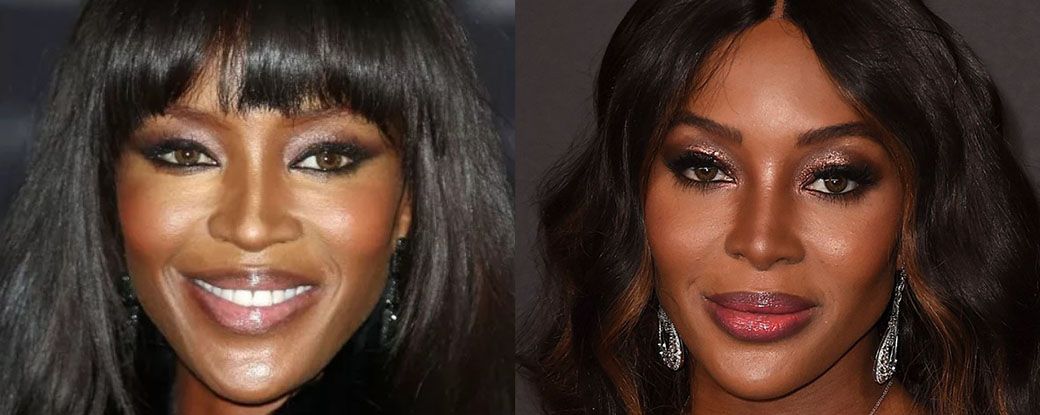 Ринопластика Наоми