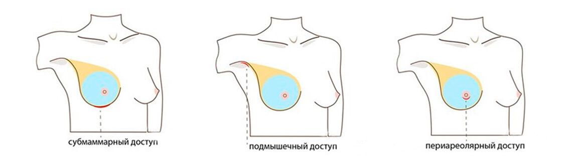 Виды доступа для&nbsp;введения имплантов