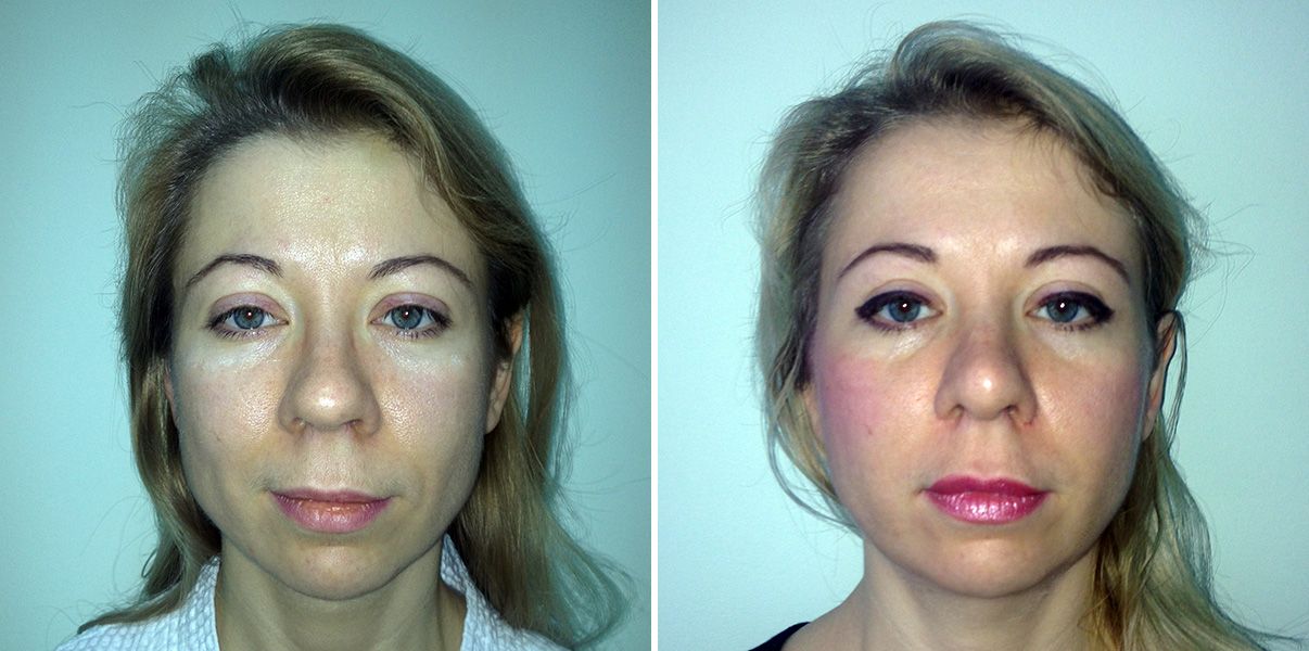 Омоложение с нитями Силуэт Лифт