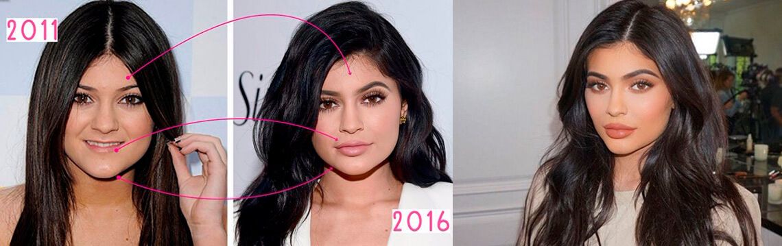 Кайли Дженнер до и после пластики