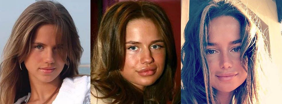 Алекса до&nbsp;и&nbsp;после пластики