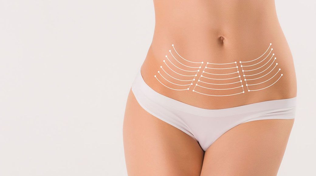 Эндоскопическая абдоминопластика