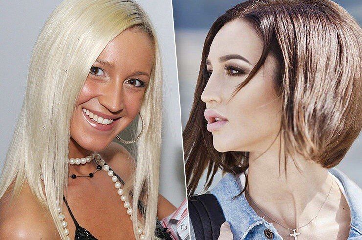 Нос Бузовой после пластики