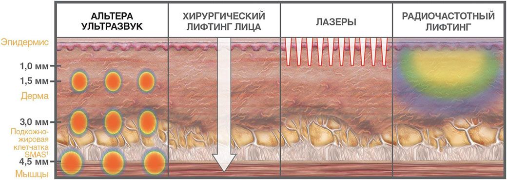 Ультразвуковой SMAS-лифтинг