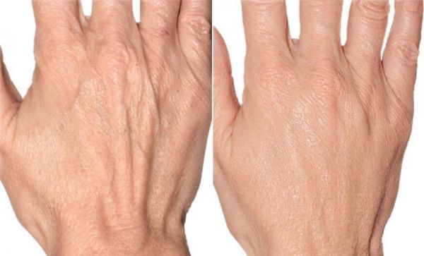 Эффект от мезотерапии рук