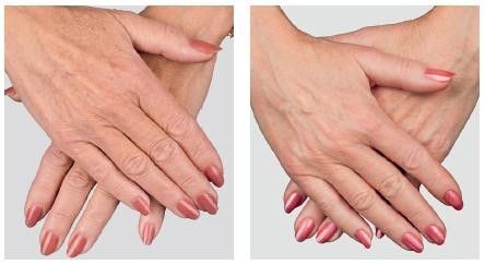 Результат мезотерапии кистей рук
