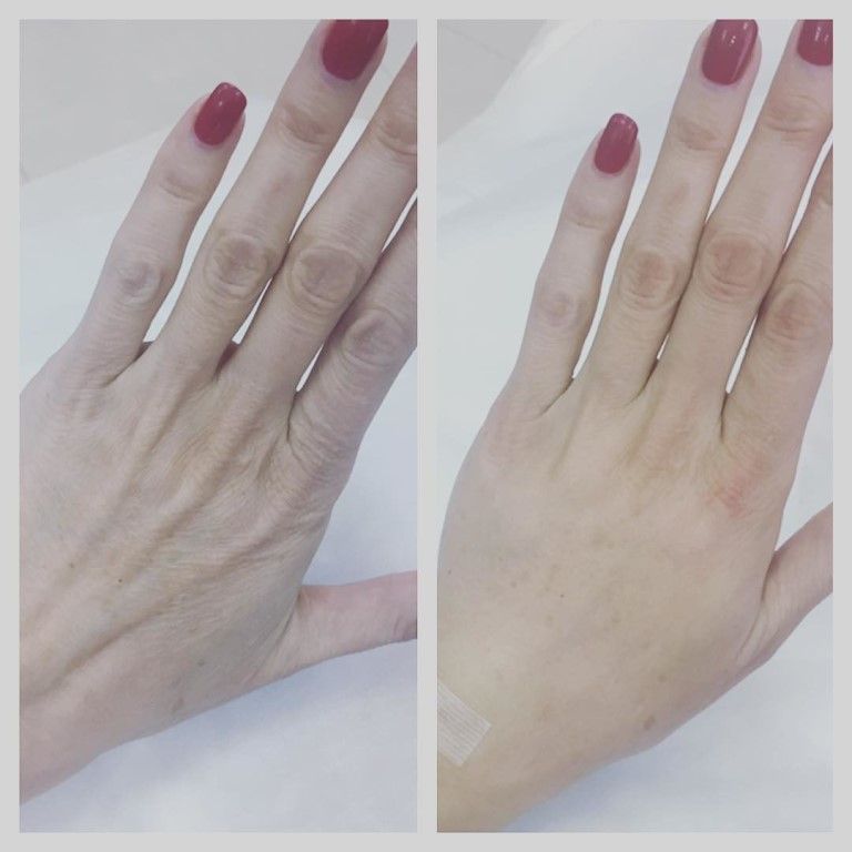 Биоревитализация кожи рук