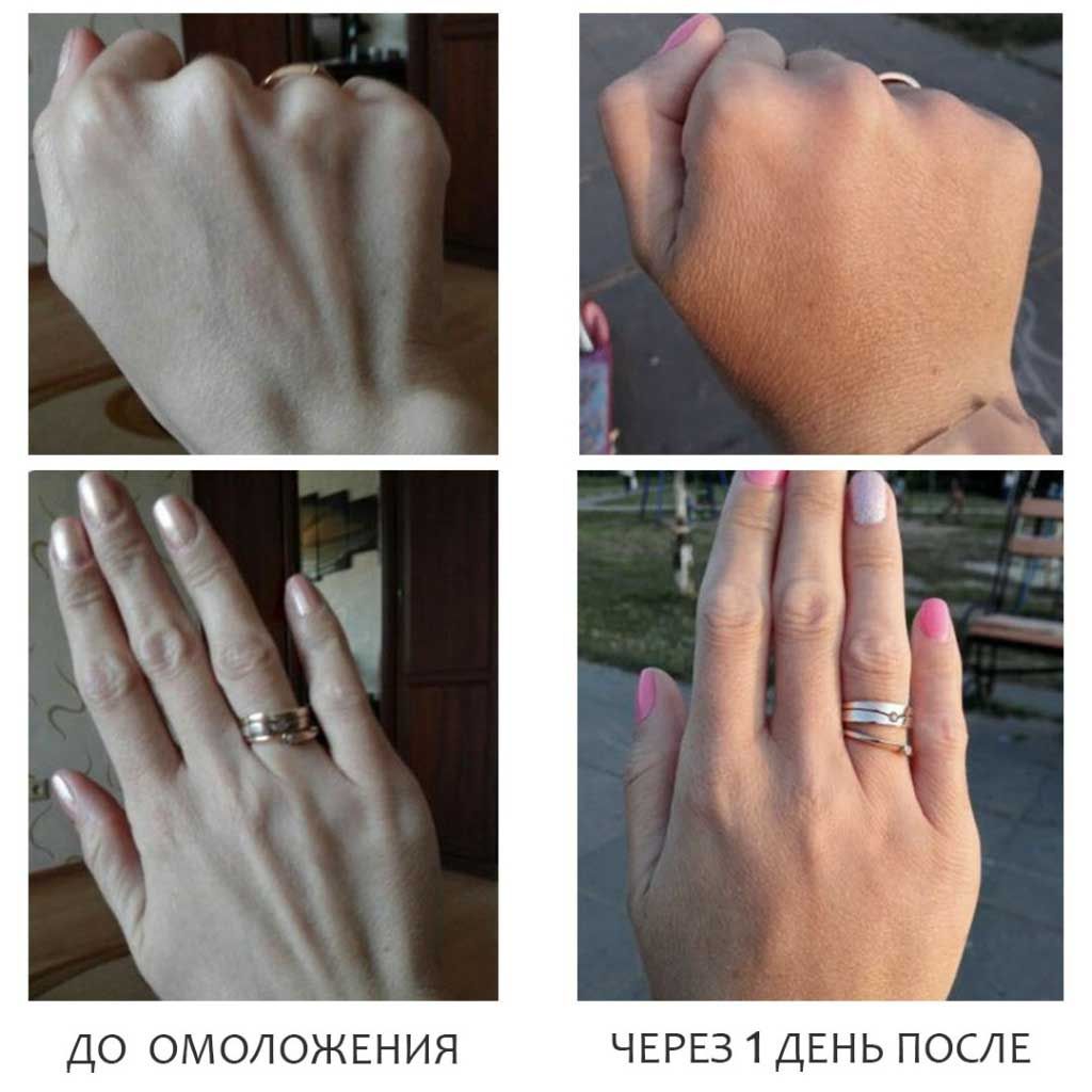 Липофилинг рук