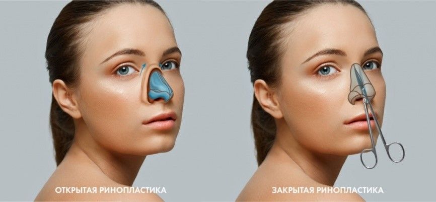 Открытая и&nbsp;закрытая ринопластика