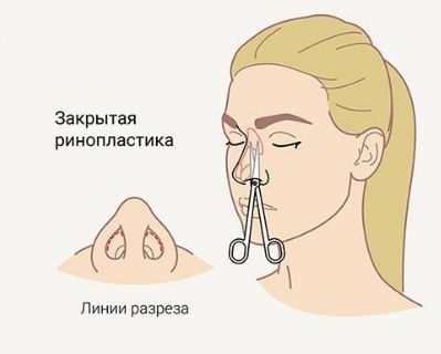 закрытая ринопластика