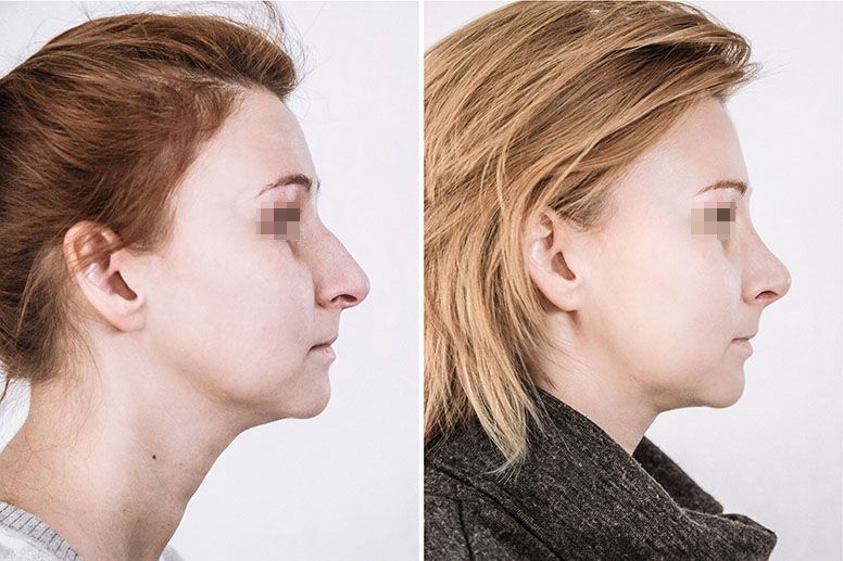 закрытая пластика