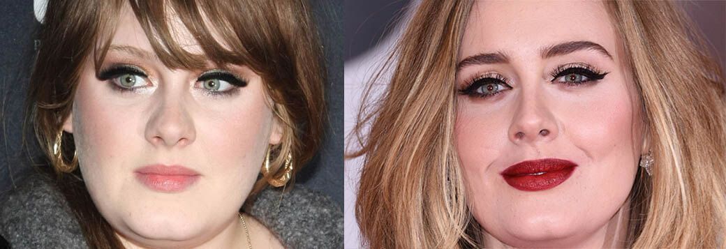 Адель ринопластика