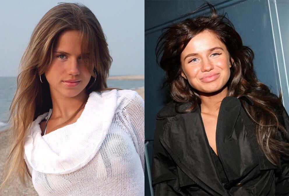 Алекса до и после пластики губ