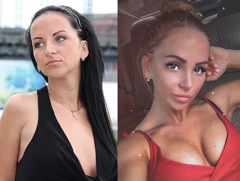 Александра Ульянцева маммопластика