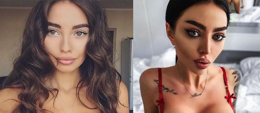 Алена Омович губы и&nbsp;скулы