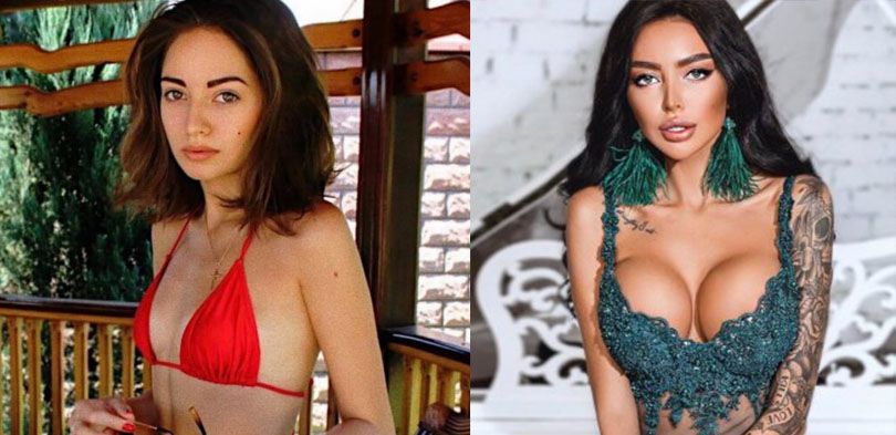 Алена Омович маммопластика