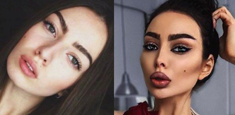 Алена Омович ринопластика