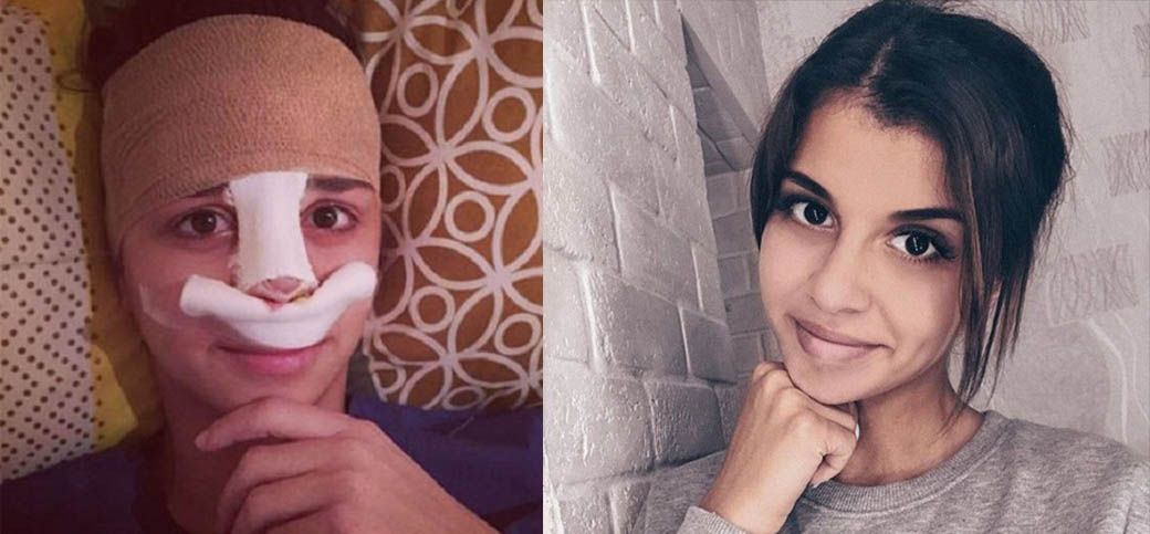 Алиана Устиненко на&nbsp;ринопластика