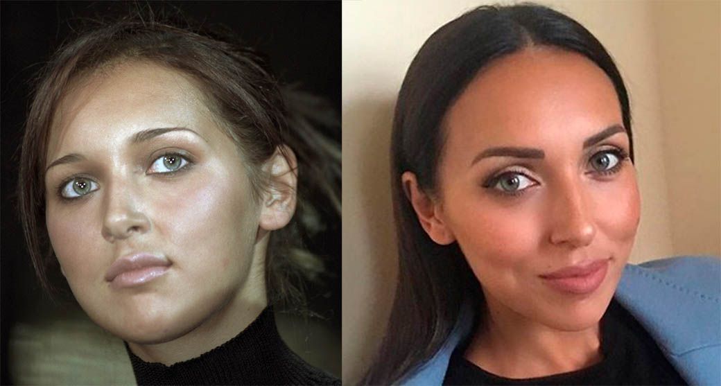 Алсу блефаропластика