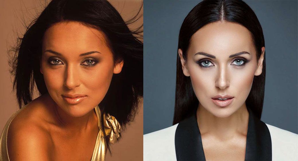 Алсу ринопластика