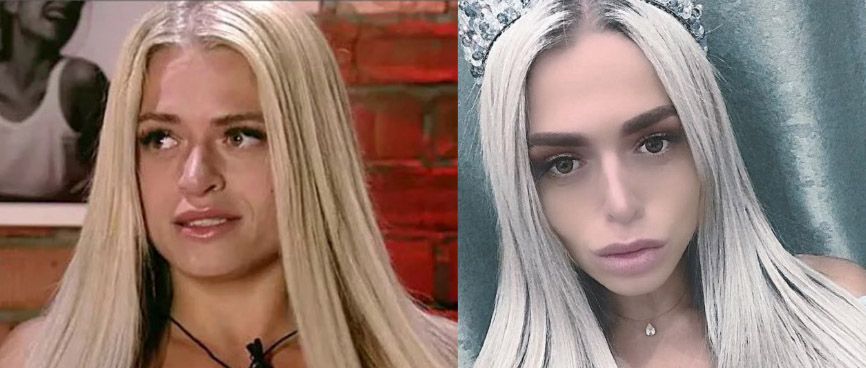 Анастасия Балинская после ринопластики