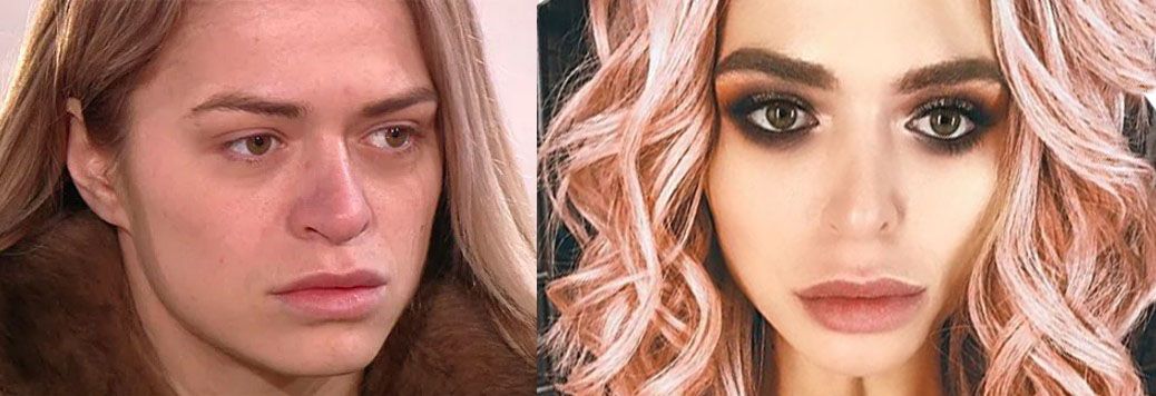 Анастасия Балинская после ринопластики