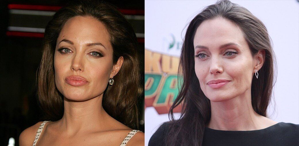 Джоли до&nbsp;и&nbsp;после уменьшения губ