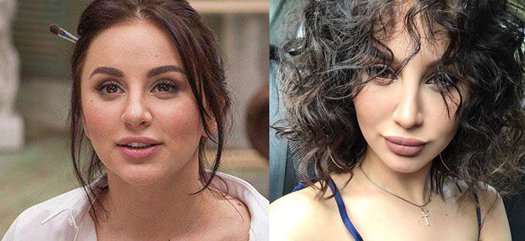 Анна Дзюба филлеры